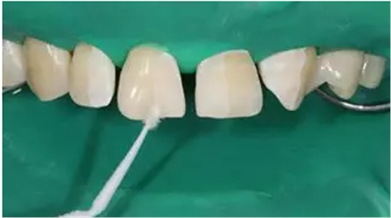 病例分享|復(fù)合樹脂微創(chuàng)美學(xué)修復(fù)關(guān)閉上前牙間隙 病例分享|復(fù)合樹脂微創(chuàng)美學(xué)修復(fù)關(guān)閉上前牙間隙