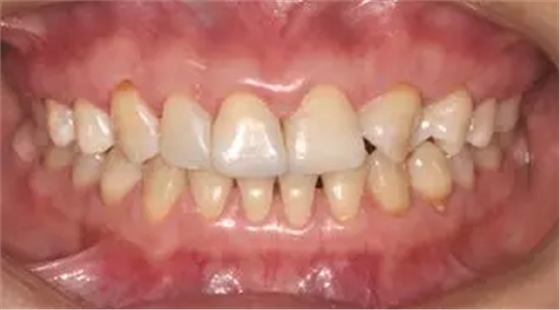 病例分享|復(fù)合樹脂微創(chuàng)美學(xué)修復(fù)關(guān)閉上前牙間隙 病例分享|復(fù)合樹脂微創(chuàng)美學(xué)修復(fù)關(guān)閉上前牙間隙