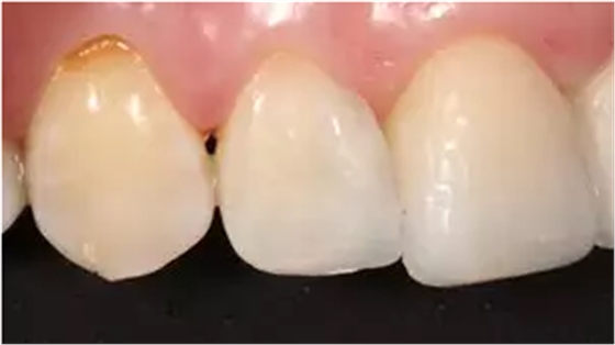 病例分享|復(fù)合樹脂微創(chuàng)美學(xué)修復(fù)關(guān)閉上前牙間隙 病例分享|復(fù)合樹脂微創(chuàng)美學(xué)修復(fù)關(guān)閉上前牙間隙