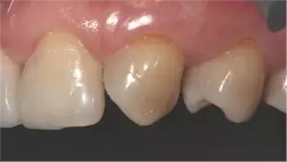 病例分享|復(fù)合樹脂微創(chuàng)美學(xué)修復(fù)關(guān)閉上前牙間隙 病例分享|復(fù)合樹脂微創(chuàng)美學(xué)修復(fù)關(guān)閉上前牙間隙