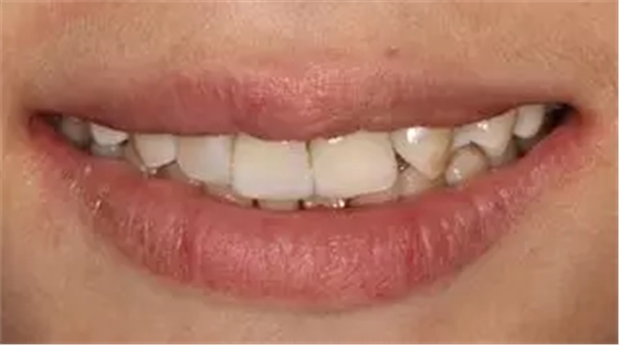 病例分享|復(fù)合樹脂微創(chuàng)美學(xué)修復(fù)關(guān)閉上前牙間隙 病例分享|復(fù)合樹脂微創(chuàng)美學(xué)修復(fù)關(guān)閉上前牙間隙