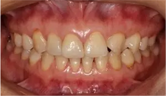 病例分享|復(fù)合樹脂微創(chuàng)美學(xué)修復(fù)關(guān)閉上前牙間隙 病例分享|復(fù)合樹脂微創(chuàng)美學(xué)修復(fù)關(guān)閉上前牙間隙