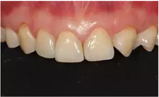 病例分享|復(fù)合樹脂微創(chuàng)美學(xué)修復(fù)關(guān)閉上前牙間隙 病例分享|復(fù)合樹脂微創(chuàng)美學(xué)修復(fù)關(guān)閉上前牙間隙