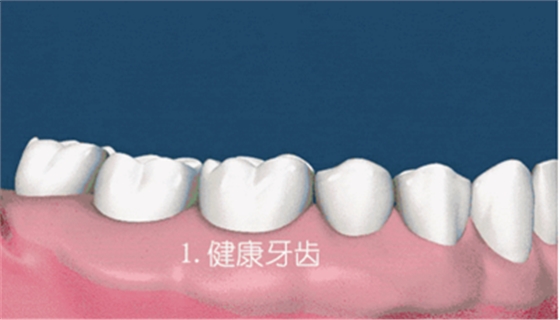 牙齦萎縮怎么辦？