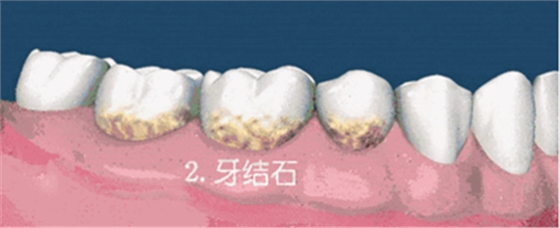 牙齦萎縮怎么辦？