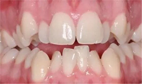 牙齦萎縮怎么辦？