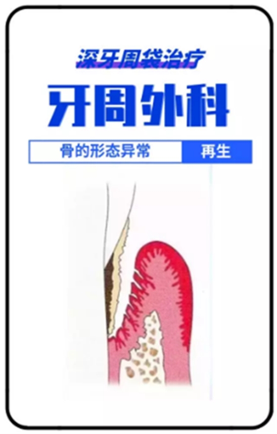 深牙周袋的治療 深牙周袋的治療
