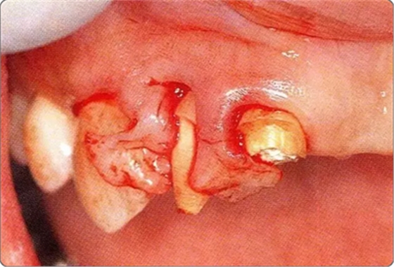 深牙周袋的治療 深牙周袋的治療