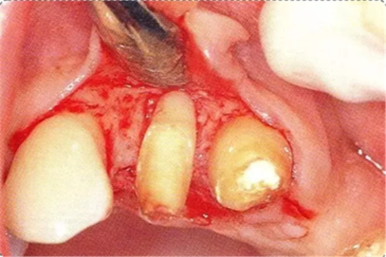 深牙周袋的治療 深牙周袋的治療