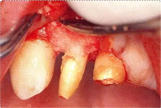 深牙周袋的治療 深牙周袋的治療