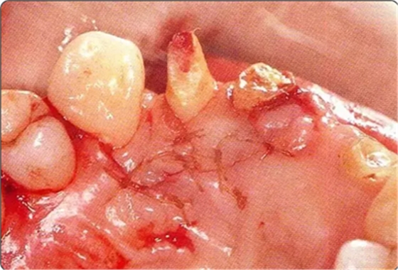 深牙周袋的治療 深牙周袋的治療