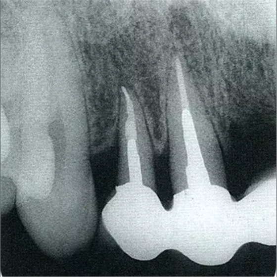 深牙周袋的治療 深牙周袋的治療