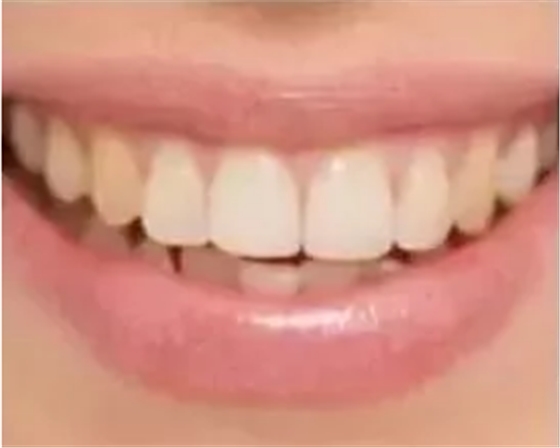 瓷貼面修復體最終顏色的影響因素 瓷貼面修復體最終顏色的影響因素