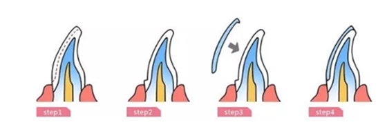 瓷貼面修復體最終顏色的影響因素 瓷貼面修復體最終顏色的影響因素