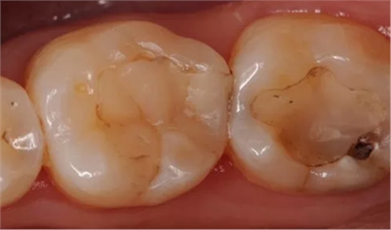 復(fù)合樹(shù)脂直接粘接牙體修復(fù)技術(shù)臨床常見(jiàn)問(wèn)題及處理