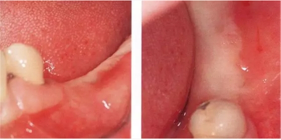 種植體周圍角化齦的獲得時期與方法 種植體周圍角化齦的獲得時期與方法