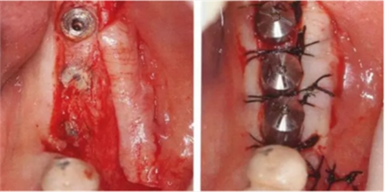 種植體周圍角化齦的獲得時期與方法 種植體周圍角化齦的獲得時期與方法