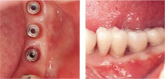 種植體周圍角化齦的獲得時期與方法 種植體周圍角化齦的獲得時期與方法