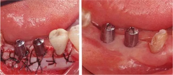 種植體周圍角化齦的獲得時期與方法 種植體周圍角化齦的獲得時期與方法