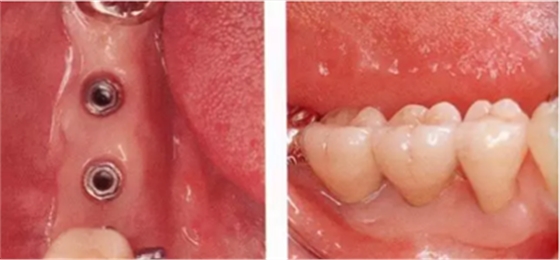 種植體周圍角化齦的獲得時期與方法 種植體周圍角化齦的獲得時期與方法