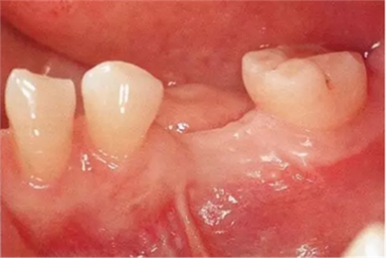 種植體周圍角化齦的獲得時期與方法 種植體周圍角化齦的獲得時期與方法