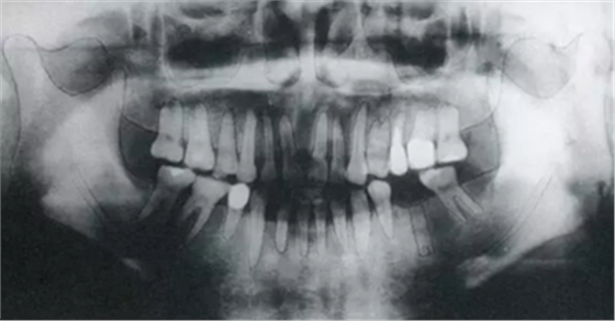 種植體周圍角化齦的獲得時期與方法 種植體周圍角化齦的獲得時期與方法