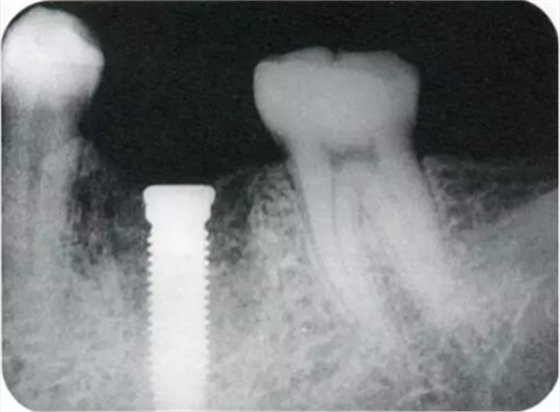 種植體周圍角化齦的獲得時期與方法 種植體周圍角化齦的獲得時期與方法