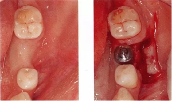 種植體周圍角化齦的獲得時期與方法 種植體周圍角化齦的獲得時期與方法