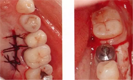 種植體周圍角化齦的獲得時期與方法 種植體周圍角化齦的獲得時期與方法