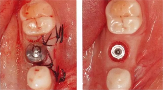 種植體周圍角化齦的獲得時期與方法 種植體周圍角化齦的獲得時期與方法