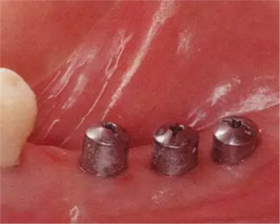 種植體周圍角化齦的獲得時期與方法 種植體周圍角化齦的獲得時期與方法