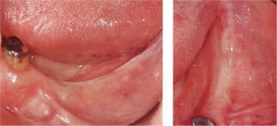 種植體周圍角化齦的獲得時期與方法 種植體周圍角化齦的獲得時期與方法