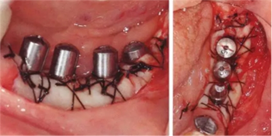 種植體周圍角化齦的獲得時期與方法 種植體周圍角化齦的獲得時期與方法