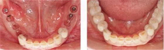 種植體周圍角化齦的獲得時期與方法 種植體周圍角化齦的獲得時期與方法
