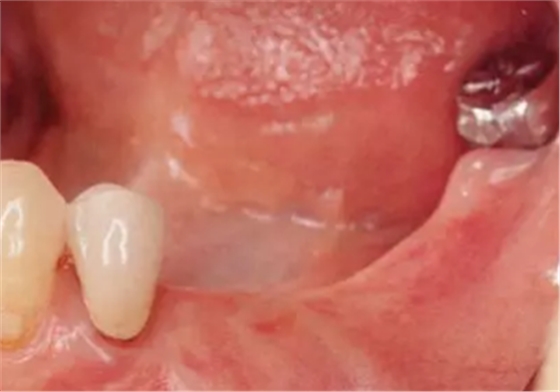 種植體周圍角化齦的獲得時期與方法 種植體周圍角化齦的獲得時期與方法