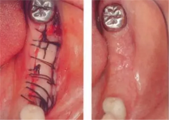 種植體周圍角化齦的獲得時期與方法 種植體周圍角化齦的獲得時期與方法