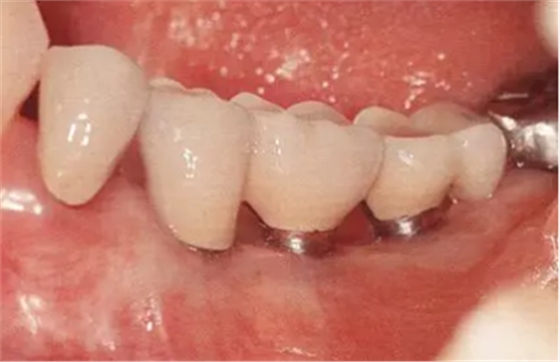 種植體周圍角化齦的獲得時期與方法 種植體周圍角化齦的獲得時期與方法