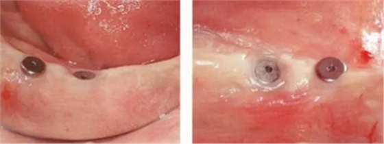 種植體周圍角化齦的獲得時期與方法 種植體周圍角化齦的獲得時期與方法