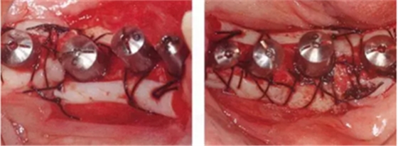 種植體周圍角化齦的獲得時期與方法 種植體周圍角化齦的獲得時期與方法