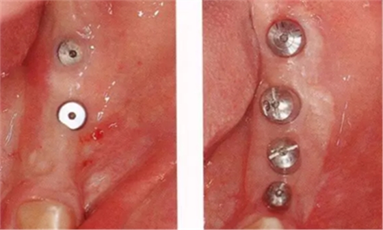 種植體周圍角化齦的獲得時期與方法 種植體周圍角化齦的獲得時期與方法