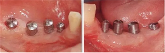 種植體周圍角化齦的獲得時期與方法 種植體周圍角化齦的獲得時期與方法