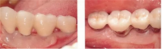 種植體周圍角化齦的獲得時期與方法 種植體周圍角化齦的獲得時期與方法