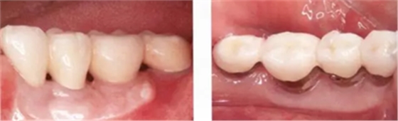 種植體周圍角化齦的獲得時期與方法 種植體周圍角化齦的獲得時期與方法
