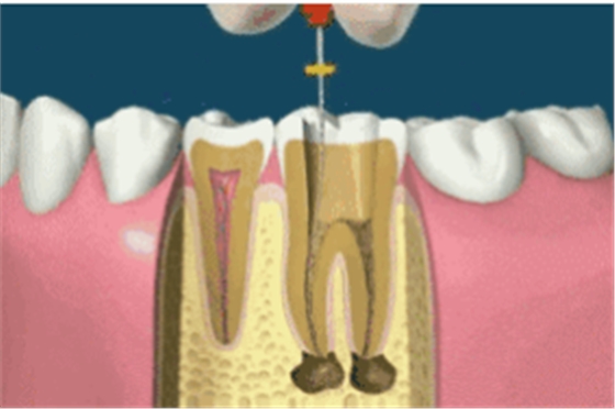 補(bǔ)牙不做冠，療效少一半！根管治療后牙齒已經(jīng)不疼了，為什么還要戴牙冠呢？