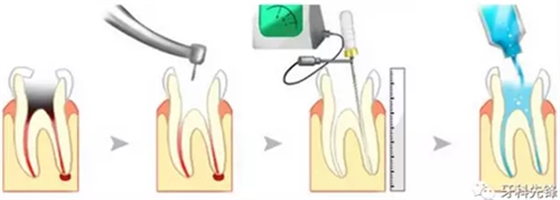 補(bǔ)牙不做冠，療效少一半！根管治療后牙齒已經(jīng)不疼了，為什么還要戴牙冠呢？