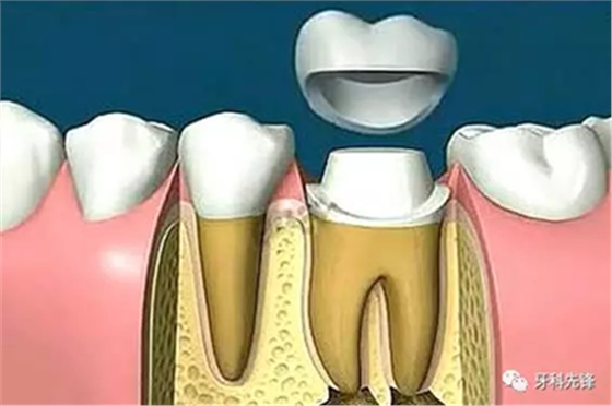 補(bǔ)牙不做冠，療效少一半！根管治療后牙齒已經(jīng)不疼了，為什么還要戴牙冠呢？