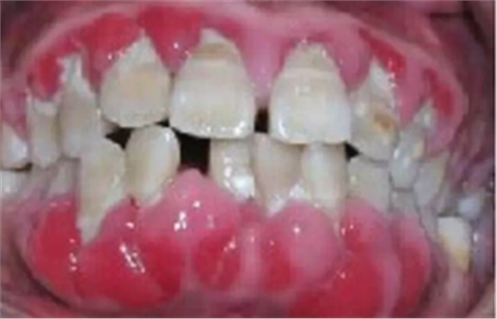 什么叫牙周病 | 品瑞邁格磁致伸縮治療儀保駕護(hù)航 什么叫牙周病 | 品瑞邁格磁致伸縮治療儀保駕護(hù)航