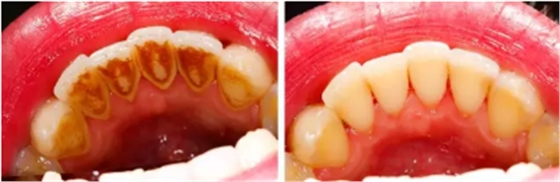 為什么洗牙后還要做牙周刮治？