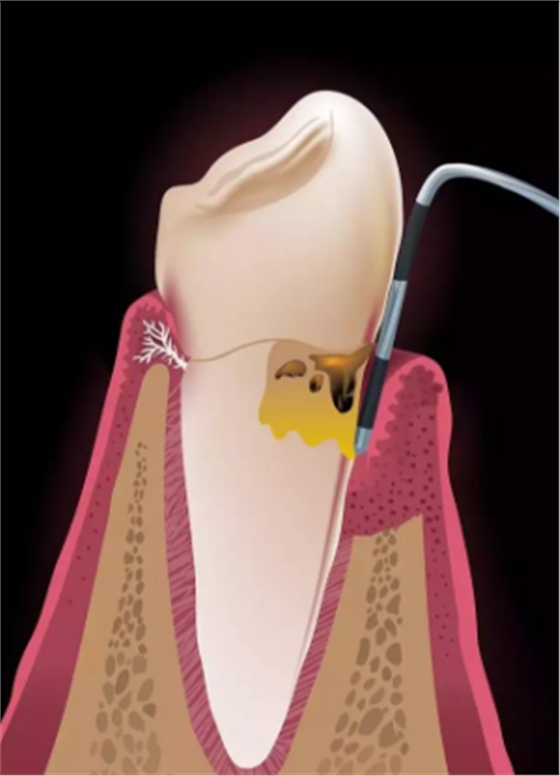 為什么洗牙后還要做牙周刮治？