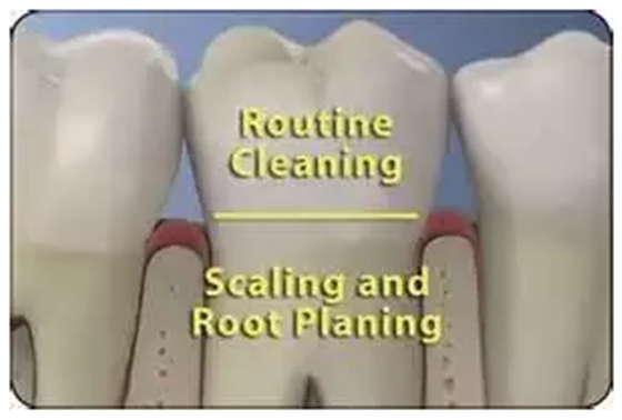 為什么洗牙后還要做牙周刮治？
